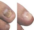 ongle-mycose-1.jpg